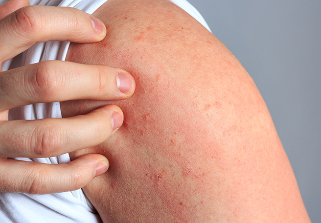 Hautausschlag am Arm