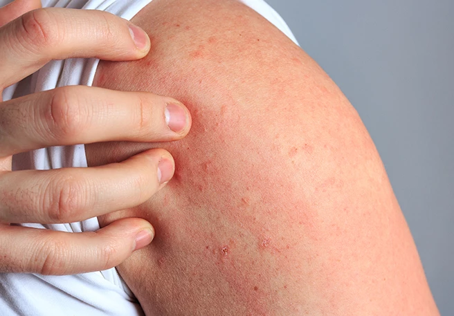 Hautausschlag am Arm Hautausschlag am Arm